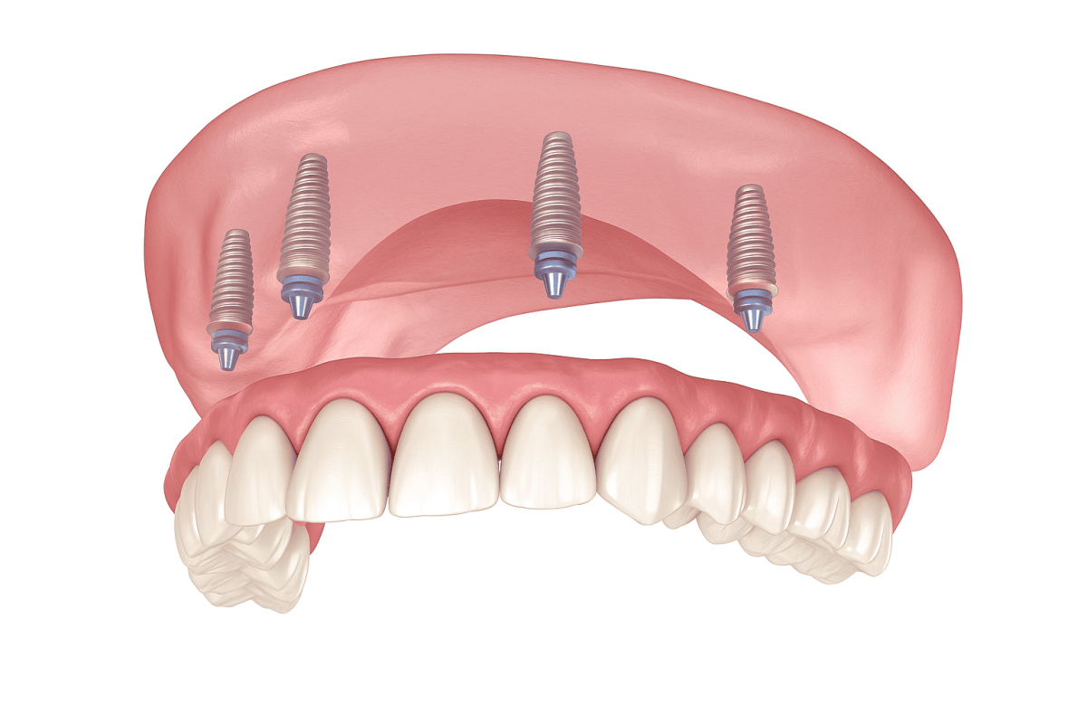 Имплантация all-on-4 Osstem с полным зубным протезом Имплантация all-on-4 Osstem с полным зубным протезом