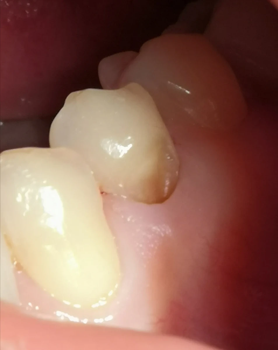 Клиновидный дефект и кариес под десной Клиновидный дефект и кариес под десной