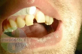 Реставрация переднего зуба Реставрация переднего зуба