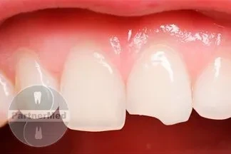 Реставрация скола зуба Реставрация скола зуба