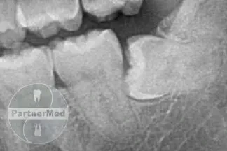 Удаление зуба мудрости Удаление зуба мудрости