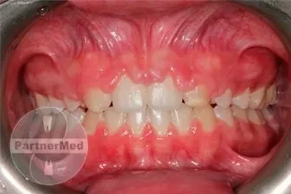 Лечение десен (гингивит) Лечение десен (гингивит)