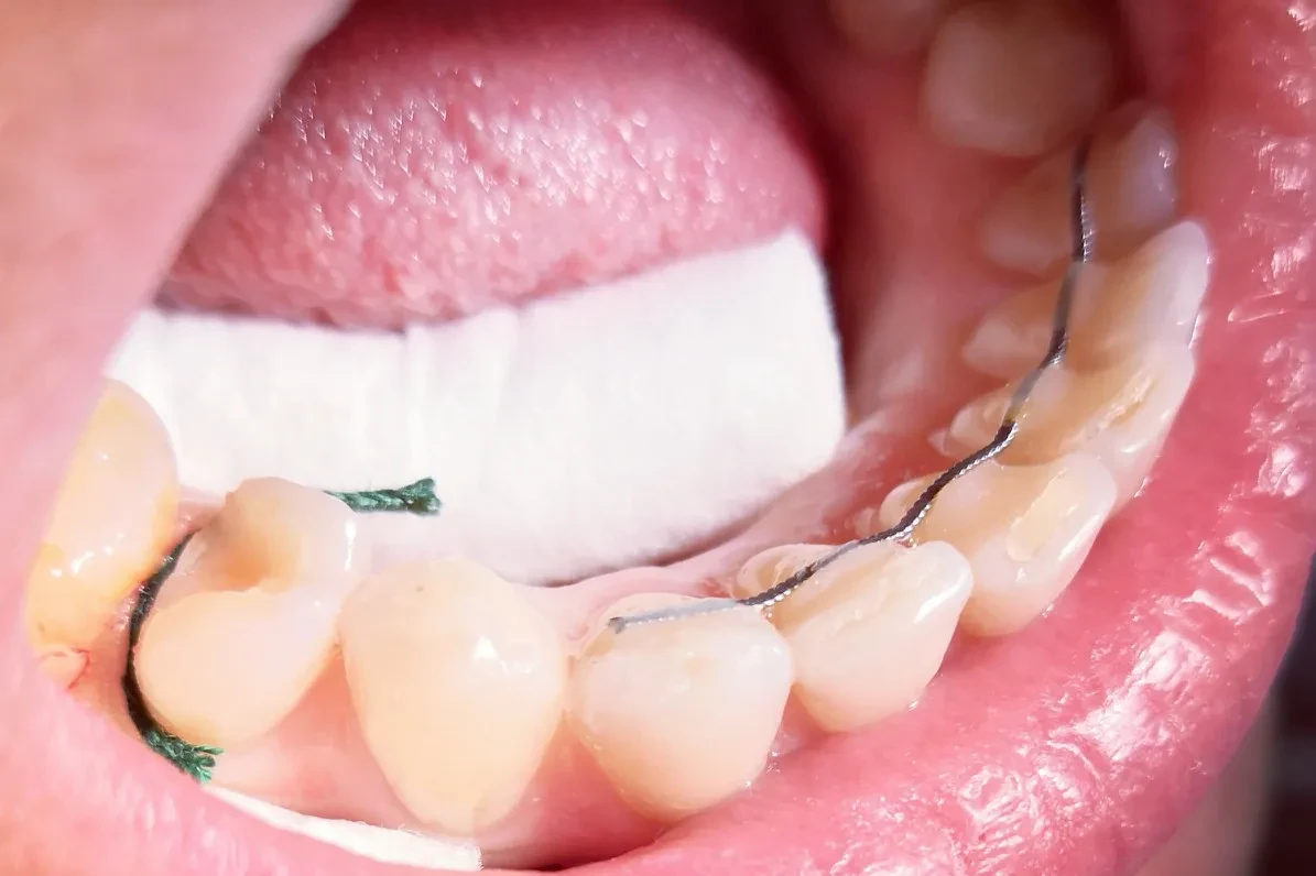 Светоотверждаемая композитная пломба Светоотверждаемая композитная пломба