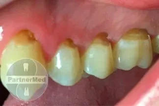 Лечение клиновидных дефектов Лечение клиновидных дефектов