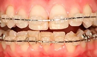 Брекеты до/после Брекеты до/после