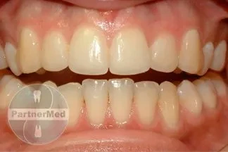 Исправление мезиального прикуса Исправление мезиального прикуса