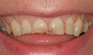 Бруксизм (вариант 2) Бруксизм (вариант 2)