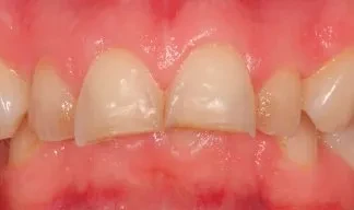 Бруксизм Бруксизм