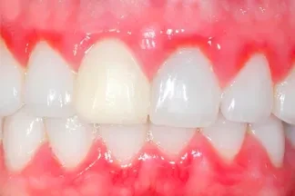 Лечение гингивита Лечение гингивита